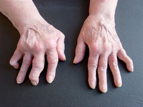 romotoid artritli kisi bacaklari